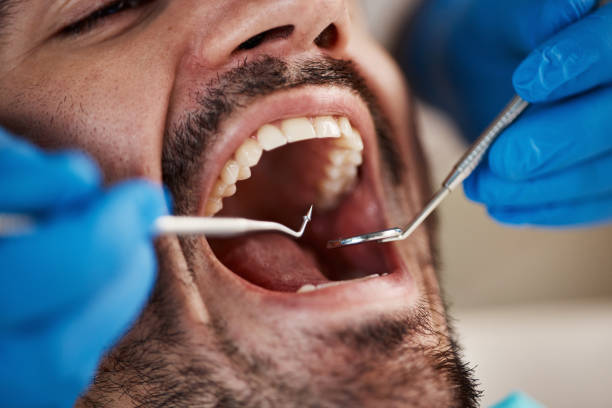 Best Emergency Treatment for Dental Infections or Abscesses in Marist College, NY