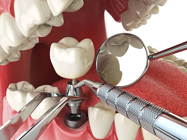Best Emergency Treatment for Dental Infections or Abscesses in Marist College, NY